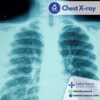 Chest X-ray (ปอดและหัวใจ)